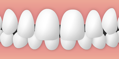 出っ歯の矯正