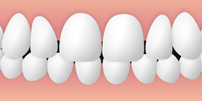 八重歯の矯正