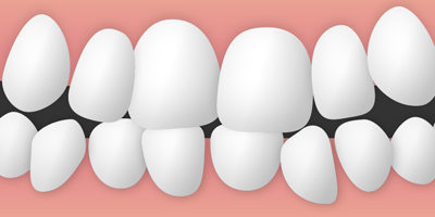 歯がガタガタ(叢生)